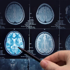 Epilepsia y desestigmatización: la clave para mejorar la calidad  de vida
