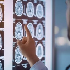 Seis recomendaciones de la neurociencia para mejorar la calidad de vida en pacientes con esclerosis múltiple