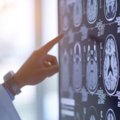 Hipertensión arterial, el enemigo silencioso que puede producir un ACV